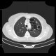 Bronchiectasia, cystic bronchiectasia: CT - Computed tomography